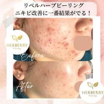 圧倒的!肌質改善するならリベルハーブピーリング!