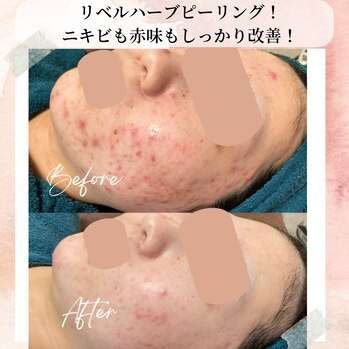 繰り返すニキビにはリベルハーブピーリングで解決!!